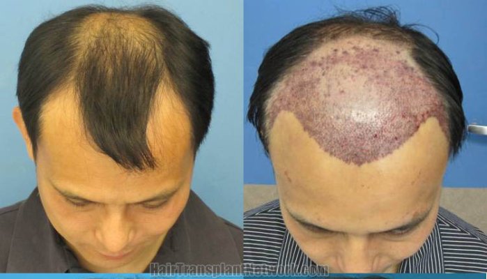 how to regrow hair on a receding hairline